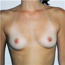 Breast Augmentation Before Photo by Steve Laverson, MD, FACS; Rancho Santa Fe, CA - Case 41779