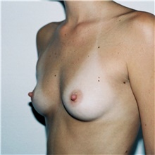 Breast Augmentation Before Photo by Steve Laverson, MD, FACS; Rancho Santa Fe, CA - Case 41779