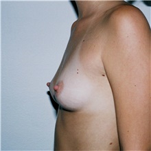 Breast Augmentation Before Photo by Steve Laverson, MD, FACS; Rancho Santa Fe, CA - Case 41779