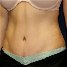 Tummy Tuck After Photo by Steve Laverson, MD, FACS; Rancho Santa Fe, CA - Case 41865