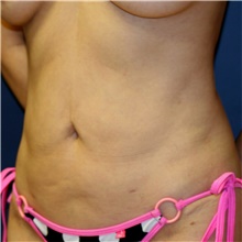 Tummy Tuck Before Photo by Steve Laverson, MD, FACS; Rancho Santa Fe, CA - Case 41865