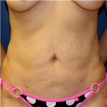 Tummy Tuck Before Photo by Steve Laverson, MD, FACS; Rancho Santa Fe, CA - Case 41865