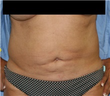 Tummy Tuck Before Photo by Steve Laverson, MD; San Diego, CA - Case 41935