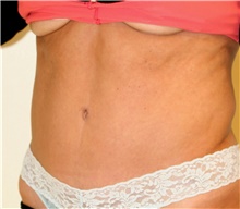 Tummy Tuck After Photo by Steve Laverson, MD; San Diego, CA - Case 41935