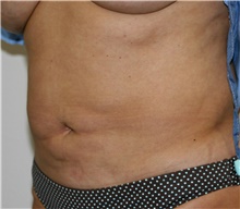 Tummy Tuck Before Photo by Steve Laverson, MD; San Diego, CA - Case 41935