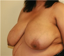 Breast Reduction Before Photo by Steve Laverson, MD, FACS; San Diego, CA - Case 41936