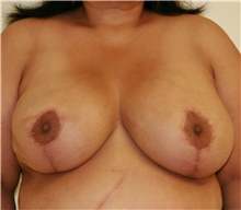 Breast Reduction After Photo by Steve Laverson, MD, FACS; San Diego, CA - Case 41936