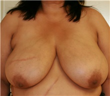Breast Reduction Before Photo by Steve Laverson, MD, FACS; San Diego, CA - Case 41936