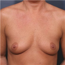 Breast Augmentation Before Photo by Steve Laverson, MD, FACS; Rancho Santa Fe, CA - Case 41996