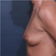 Breast Augmentation Before Photo by Steve Laverson, MD, FACS; Rancho Santa Fe, CA - Case 41996