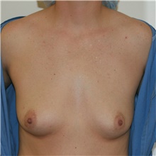 Breast Augmentation Before Photo by Steve Laverson, MD, FACS; Rancho Santa Fe, CA - Case 41997