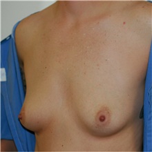 Breast Augmentation Before Photo by Steve Laverson, MD, FACS; Rancho Santa Fe, CA - Case 41997