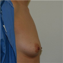 Breast Augmentation Before Photo by Steve Laverson, MD, FACS; Rancho Santa Fe, CA - Case 41997