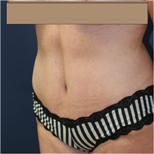 Tummy Tuck After Photo by Steve Laverson, MD, FACS; Rancho Santa Fe, CA - Case 42007