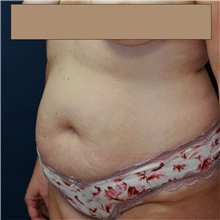 Tummy Tuck Before Photo by Steve Laverson, MD, FACS; Rancho Santa Fe, CA - Case 42007