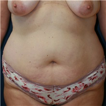 Tummy Tuck Before Photo by Steve Laverson, MD, FACS; Rancho Santa Fe, CA - Case 42007