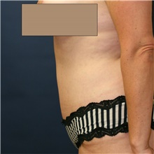 Tummy Tuck After Photo by Steve Laverson, MD, FACS; Rancho Santa Fe, CA - Case 42007