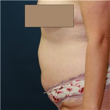 Tummy Tuck Before Photo by Steve Laverson, MD, FACS; Rancho Santa Fe, CA - Case 42007