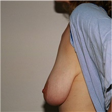 Breast Lift Before Photo by Steve Laverson, MD; San Diego, CA - Case 42016