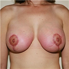 Breast Lift After Photo by Steve Laverson, MD, FACS; Rancho Santa Fe, CA - Case 42016