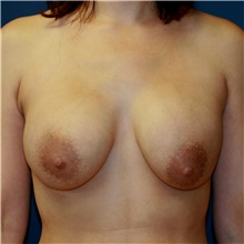 Breast Implant Revision Before Photo by Steve Laverson, MD, FACS; Rancho Santa Fe, CA - Case 42024