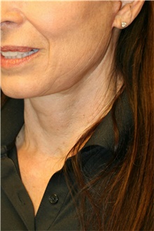 Neck Lift After Photo by Steve Laverson, MD, FACS; San Diego, CA - Case 42035