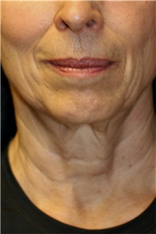 Neck Lift Before Photo by Steve Laverson, MD, FACS; San Diego, CA - Case 42035