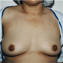 Breast Augmentation Before Photo by Steve Laverson, MD, FACS; Rancho Santa Fe, CA - Case 42036