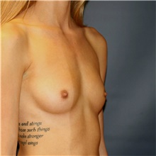 Breast Augmentation Before Photo by Steve Laverson, MD, FACS; Rancho Santa Fe, CA - Case 42037