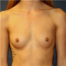 Breast Augmentation Before Photo by Steve Laverson, MD, FACS; Rancho Santa Fe, CA - Case 42037