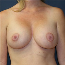 Breast Augmentation After Photo by Steve Laverson, MD, FACS; Rancho Santa Fe, CA - Case 42059