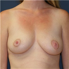 Breast Augmentation Before Photo by Steve Laverson, MD, FACS; Rancho Santa Fe, CA - Case 42059