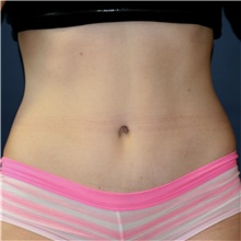 Tummy Tuck After Photo by Steve Laverson, MD, FACS; Rancho Santa Fe, CA - Case 42060