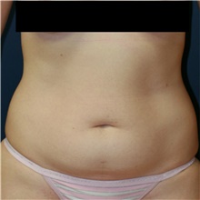 Tummy Tuck Before Photo by Steve Laverson, MD, FACS; Rancho Santa Fe, CA - Case 42060