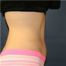 Tummy Tuck After Photo by Steve Laverson, MD, FACS; Rancho Santa Fe, CA - Case 42060