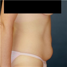 Tummy Tuck Before Photo by Steve Laverson, MD, FACS; Rancho Santa Fe, CA - Case 42060