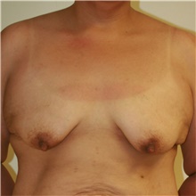 Breast Lift Before Photo by Steve Laverson, MD, FACS; Rancho Santa Fe, CA - Case 42061