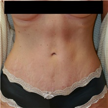 Tummy Tuck After Photo by Steve Laverson, MD; San Diego, CA - Case 42095