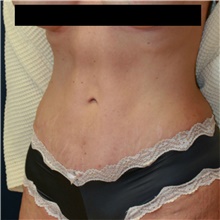 Tummy Tuck After Photo by Steve Laverson, MD, FACS; San Diego, CA - Case 42095