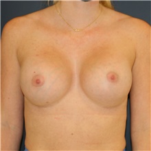 Breast Augmentation After Photo by Steve Laverson, MD, FACS; Rancho Santa Fe, CA - Case 42099