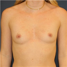 Breast Augmentation Before Photo by Steve Laverson, MD, FACS; Rancho Santa Fe, CA - Case 42099