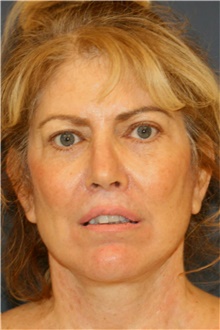 Facelift After Photo by Steve Laverson, MD, FACS; Rancho Santa Fe, CA - Case 42108