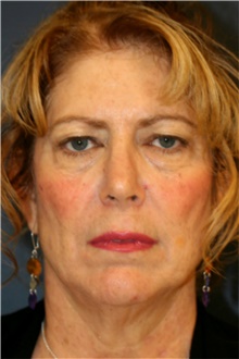 Facelift Before Photo by Steve Laverson, MD, FACS; Rancho Santa Fe, CA - Case 42108