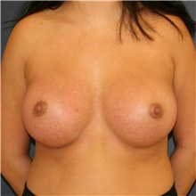 Breast Augmentation After Photo by Steve Laverson, MD, FACS; Rancho Santa Fe, CA - Case 42128