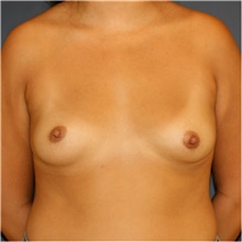 Breast Augmentation Before Photo by Steve Laverson, MD, FACS; Rancho Santa Fe, CA - Case 42128