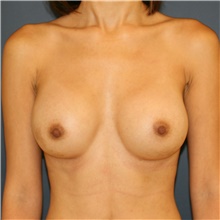 Breast Augmentation After Photo by Steve Laverson, MD, FACS; Rancho Santa Fe, CA - Case 42140