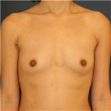 Breast Augmentation Before Photo by Steve Laverson, MD, FACS; Rancho Santa Fe, CA - Case 42140