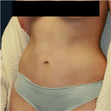 Tummy Tuck After Photo by Steve Laverson, MD, FACS; San Diego, CA - Case 42141