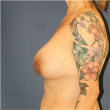 Breast Lift Before Photo by Steve Laverson, MD, FACS; Rancho Santa Fe, CA - Case 42143