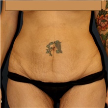 Tummy Tuck Before Photo by Steve Laverson, MD; San Diego, CA - Case 42152